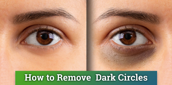 Dark Circles Under Your Eyes: Causes, Treatments & Prevention Tips