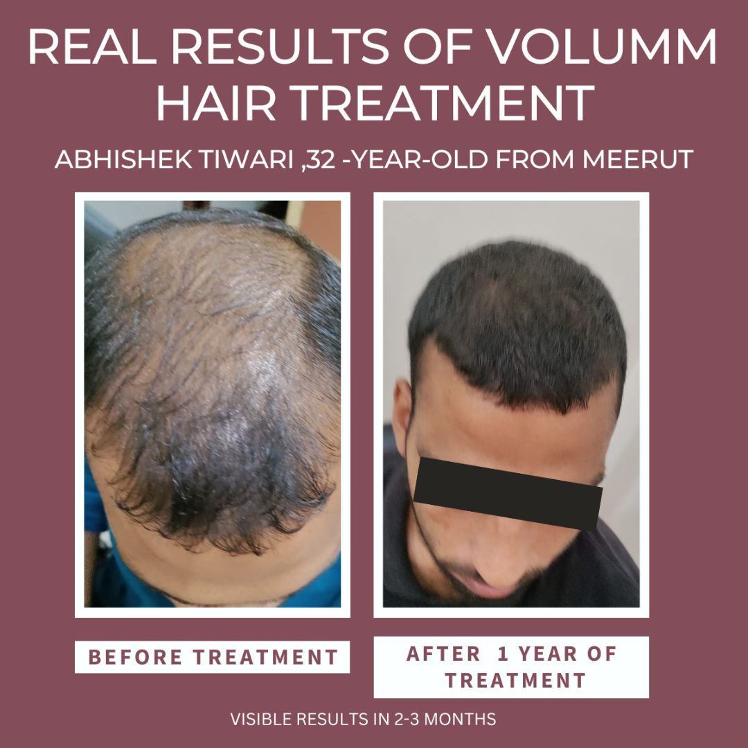 VOLUMM HAIR REGROWTH TREATMENT (FOR MEN) Razorveda